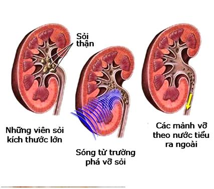 tán sỏi ngoài cơ thể