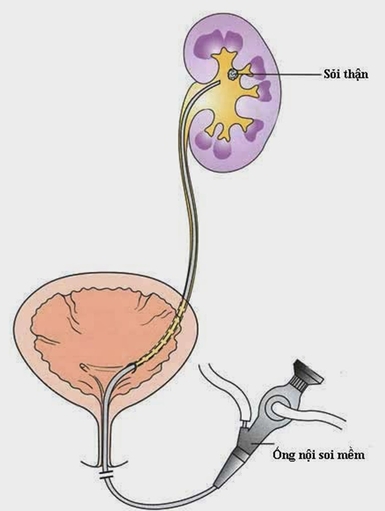 Sạch sỏi niệu quản sau 30 phút nhờ phẫu thuật bằng laser