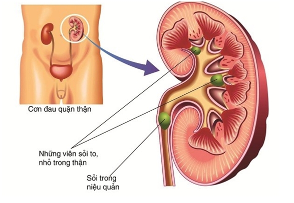 Triệu chứng sau tán sỏi niệu quản