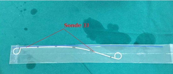 Ống sonde JJ niệu quản